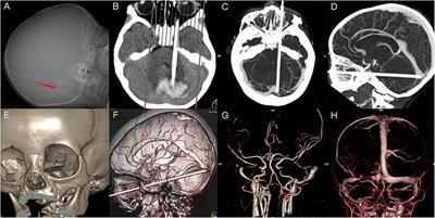 Orbitocranial Penetrating Injury With Multiple Vessel Invasion in an Infant: A Case Report and Literature Review